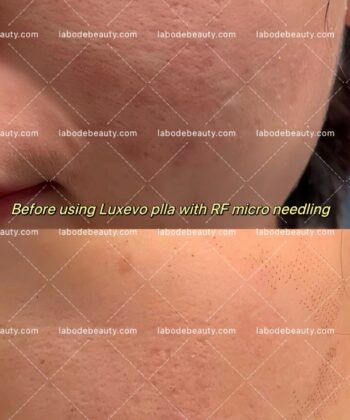 Luxevo plla before after