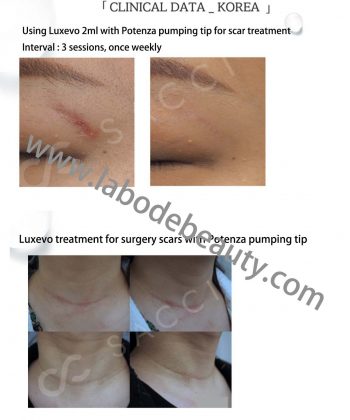 luxevo plla scar treatment before after