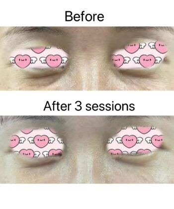 Recombinant Human Collagen before after