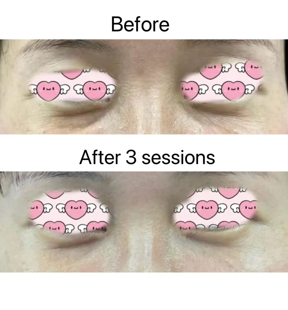 Recombinant Human Collagen before after